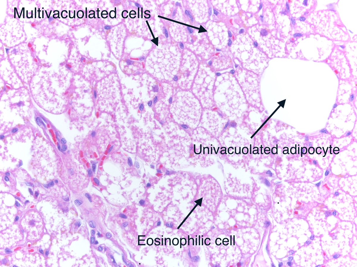 PathologySayah's tweet photo. Hibernoma #dermpath #BSTpath 
@MAHoureih @kriyer68 @preethijaison @pembeoltulu @md_kyle @ALBoothMD @sam_albadri @SSPZaragoza @MightyDermPath @DrRolaAli @AyshaMubeen86 @HENRYY_MD @MPathyart @forthejon @HermelinDaniela @D4L14H @AnnieMcLeanDMD @VKazlouskaya @SGottesmanMD @sbakhsh2 https://t.co/IkELbUQJyi