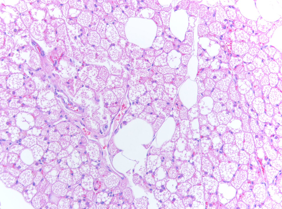 PathologySayah's tweet photo. Hibernoma #dermpath #BSTpath 
@MAHoureih @kriyer68 @preethijaison @pembeoltulu @md_kyle @ALBoothMD @sam_albadri @SSPZaragoza @MightyDermPath @DrRolaAli @AyshaMubeen86 @HENRYY_MD @MPathyart @forthejon @HermelinDaniela @D4L14H @AnnieMcLeanDMD @VKazlouskaya @SGottesmanMD @sbakhsh2 https://t.co/IkELbUQJyi