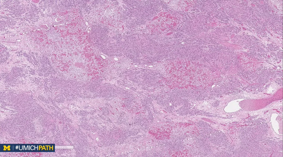 UMichPath's tweet image. 🔬#GYNPath, Day 4.

➡️What’s your #DailyDx of this uterine mass?

➡️What immunohistochemical stain would you order?

➡️We’ll tweet the answer, some quick facts, and the next case tomorrow! #UMichPath