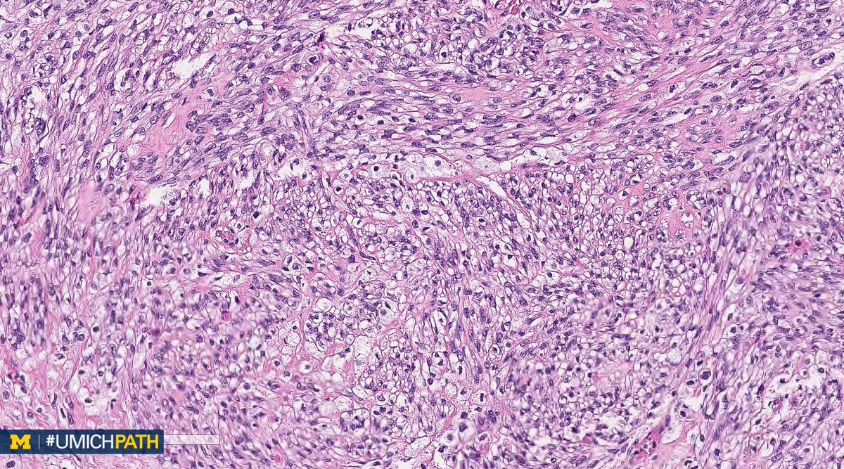 UMichPath's tweet image. 🔬#GYNPath, Day 4.

➡️What’s your #DailyDx of this uterine mass?

➡️What immunohistochemical stain would you order?

➡️We’ll tweet the answer, some quick facts, and the next case tomorrow! #UMichPath