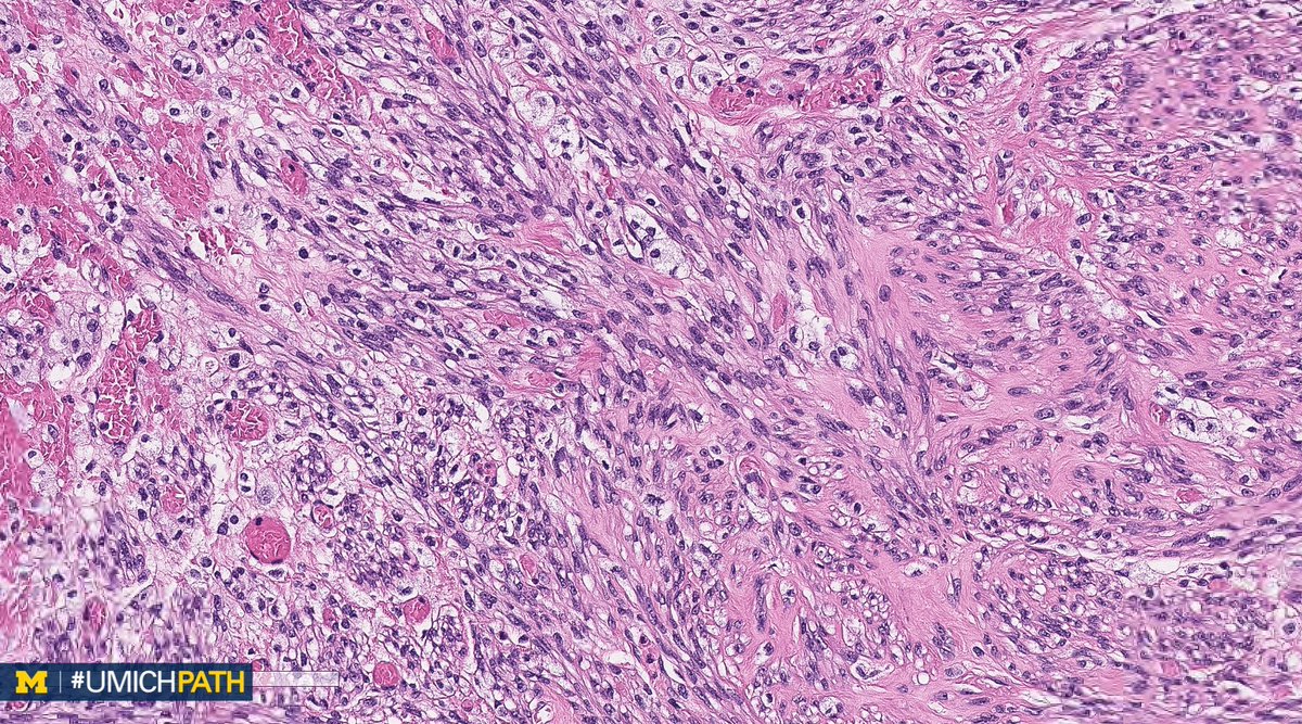 UMichPath's tweet image. 🔬#GYNPath, Day 4.

➡️What’s your #DailyDx of this uterine mass?

➡️What immunohistochemical stain would you order?

➡️We’ll tweet the answer, some quick facts, and the next case tomorrow! #UMichPath