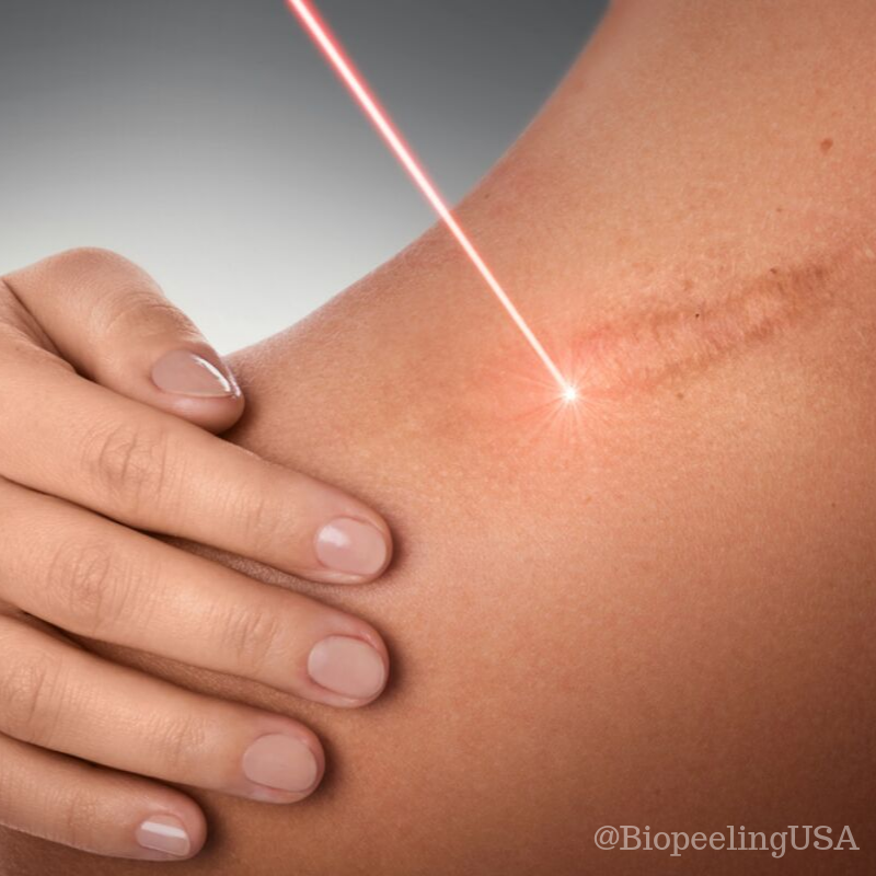 BioPeelingUSA's tweet photo. One way to treat keloids is to remove them surgically, but because most people with keloids continue to be prone to abnormal scarring, Non-surgical removal is often a more effective treatment. Reach out to us today if there is a scar you want to stop seeing. #Scar #Skincare https://t.co/joBQrafl3G