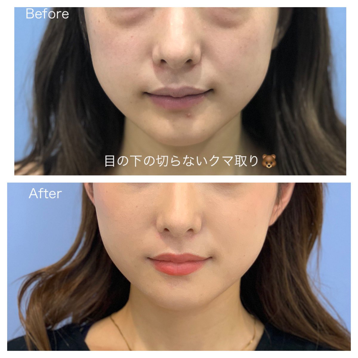 湘南美容クリニック 池袋西口院院長 多田彩子 目の下の切らないたるみ取り クマ取り 目の下のクマや 加齢とともに気になるたるみを解消 通常円 モニター価格円 無料カウンセリング モニター番号 目の下のクマ 湘南美容クリニック 池袋西口院院長 多田彩子 目の下の切らないたるみ取り クマ取り 目の下のクマや 加齢とともに気になるたるみを解消 通常円 モニター価格円 無料カウンセリング モニター番号 目の下のクマ