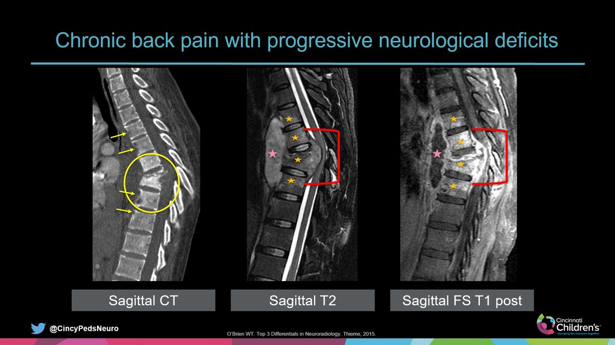 WmOBrienDO's tweet image. #SpineRad
Case for the Weekend

Single post for this case:
Slide 1: History &amp;amp; images at presentation
Slide 2: Annotated images
Slide 3: Answer &amp;amp; key points

Have a great weekend…
#PedsRad #NeuroRad #RadRes #FOAMrad