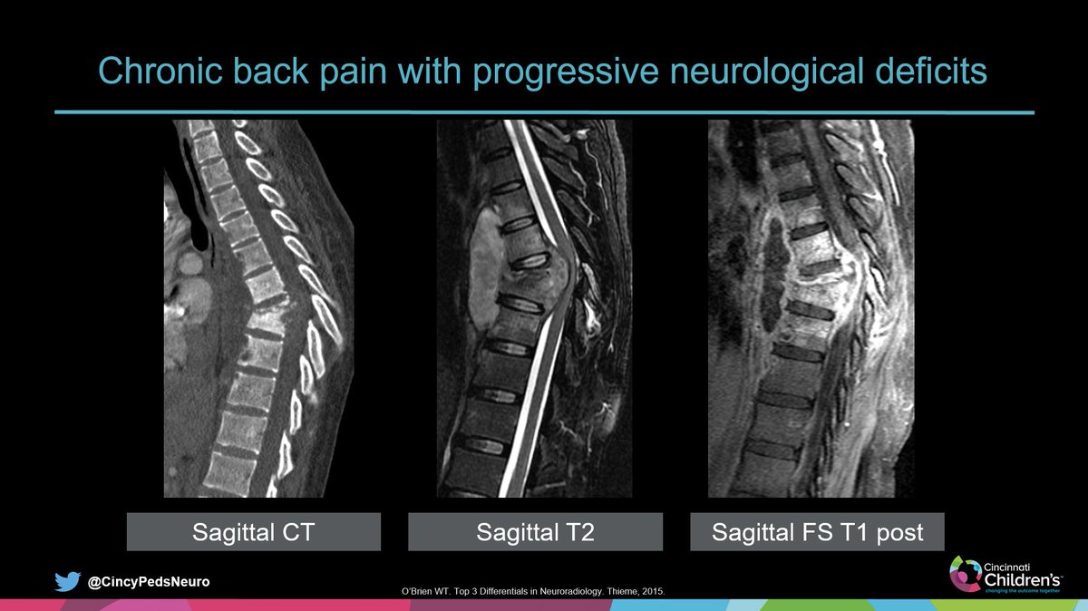 WmOBrienDO's tweet image. #SpineRad
Case for the Weekend

Single post for this case:
Slide 1: History &amp;amp; images at presentation
Slide 2: Annotated images
Slide 3: Answer &amp;amp; key points

Have a great weekend…
#PedsRad #NeuroRad #RadRes #FOAMrad