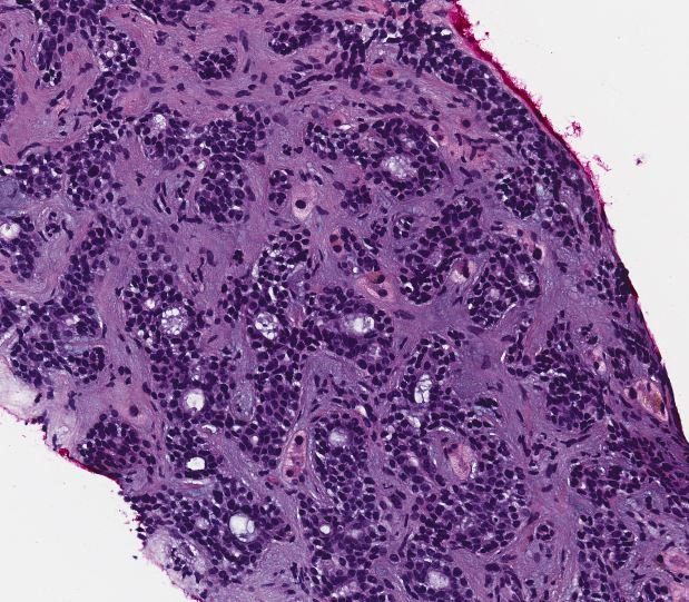 TexPathol's tweet photo. Lung mass in a 55 year old male. This is adenoid cystic carcinoma. #pulmpath https://t.co/H3CHY1o06j