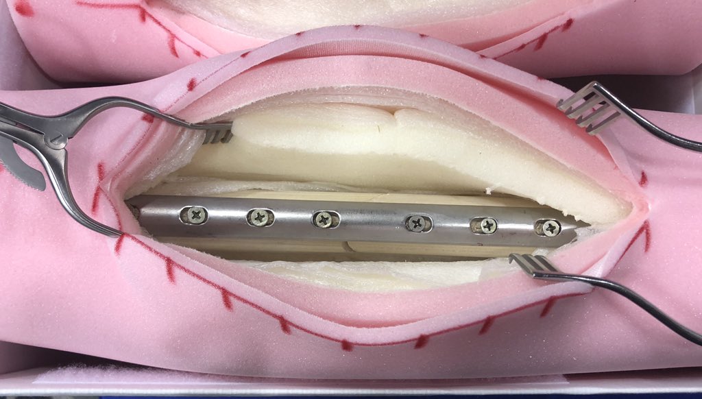 TMill1032's tweet image. ORIF Femur Fracture #FirstAssist #RNFA #NIFA