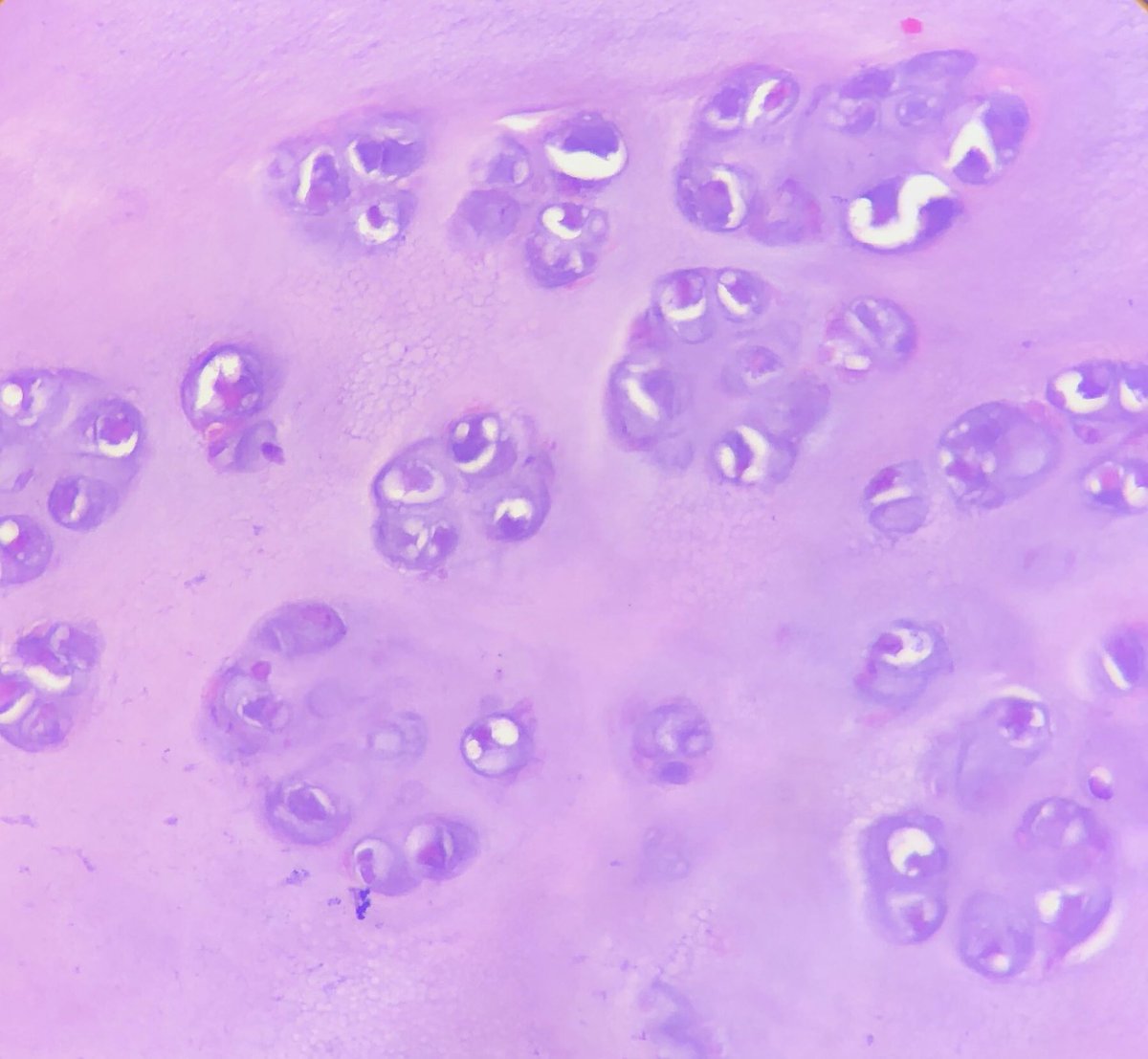 xenaalabbas's tweet photo. #Chondrosarcoma #STpath #pathology 🌸💜💗 https://t.co/8BCKq9pp9M