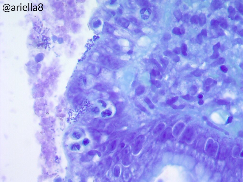 ariella8's tweet photo. Dear #GIPath this is gastric Bx sent as "atrophic gastropathy" 
1-what would be your considerations on this reactive type injury with lots of PMNs 2-how do you interpret those epithelial adherent short rods and cocci 😊🙏 https://t.co/Om3nVbxD6b