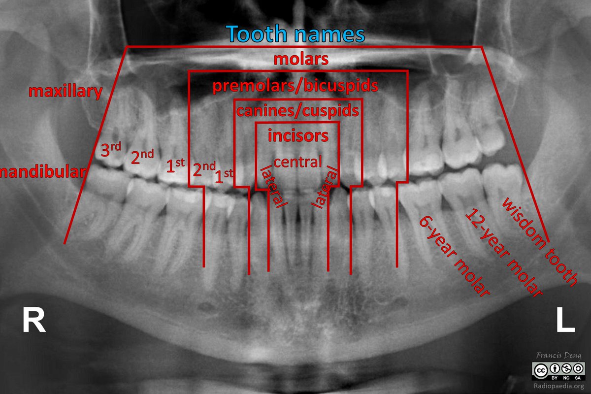 francisdeng's tweet photo. Confused about tooth nomenclature?
#Radres bookmark a reference for that panorex on call
https://t.co/oLwo1eobeB
Left maxillary first molar
Left maxillary 6-year molar
ADA 14 for the Americans
FDI 26 for the rest of the world https://t.co/77VrdR4bXm