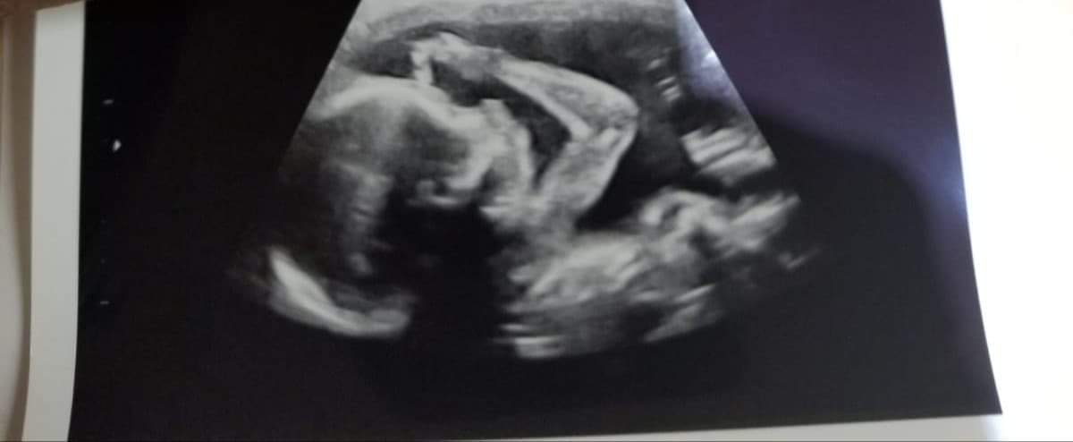 OMWills's tweet photo. 21weeks!

Say hi Twitter fam!

Lolz looks like he's already an Anime Stan like mom &amp; dad!

Look at the hand!  It looks like he's doing Naruto ninjutsu! (ninpo)  🤣😂

#animestan #21weeks #NARUTO #anime #baby https://t.co/xBeOiButWP