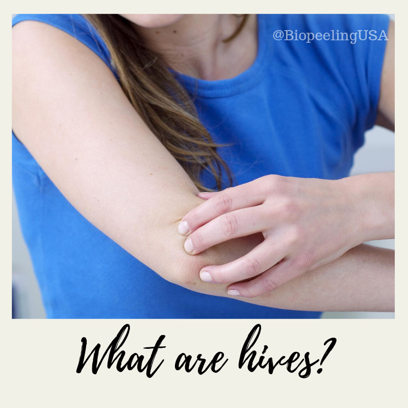 BioPeelingUSA's tweet photo. #Urticaria, also known as #hives, is an #outbreak of swollen, pale red bumps or plaques (wheals) on the #skin that appear suddenly -- either as a result of the body's reaction to certain #allergens or for unknown reasons. Call now to get your skin defect treated #Skincare #Beauty https://t.co/9WjhHJVvpW