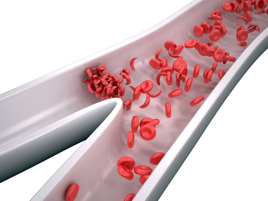 Teckymedia's tweet photo. What is sickle cell disease? Via https://t.co/O28KJPK6PX @Healthsaveblog #HealthSaveBlog #Diabetes #Health #Sickle_Cell_Disease #Sicklecell #SSD https://t.co/IdXeElPbNu