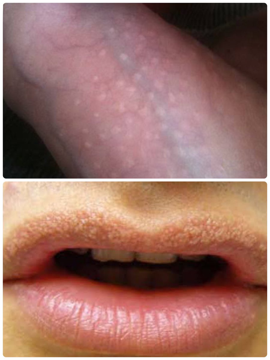 กลับมาอีกครับกับ #สาระแน่ อ่ะวันนี้เอาอาการพวกนี้มาฝาก hirsuties coronae grandis และ fordyce spot ที่หนุ่มๆสงสัยกันเยอะมาก คร่าวๆคือไม่ต้องไปแกะ เกา บีบ เค้นมันนะ ไม่ใช่อาการผิดปกติแต่อย่างใดยกเว้นจะใหญ่ขึ้น เพิ่มจำนวน เจ็บแสบ คัน ข้อมูลเพิ่มเติม <a href="/vckcoolspace/">VCK Cool Space</a> ทุกวันจันทร์นะครับ