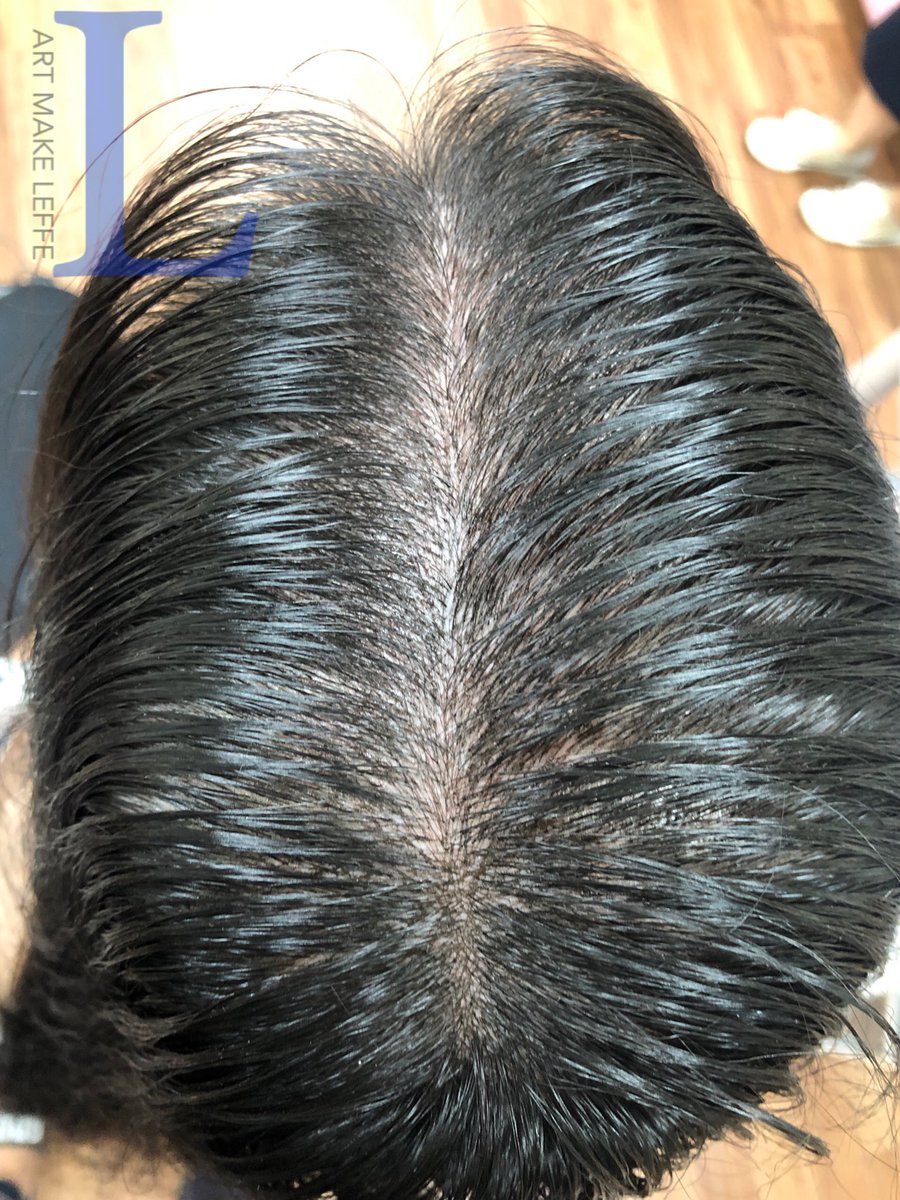 韓国アートメイク ルフェ ヘアライン新規のお客様 分け目部分だけでなく つむじ 生え際も施術可能です 毛並み 量 濃さや色素の定着度により仕上がりに個人差はございます 写真は施術当日 お客様の許可を得ています