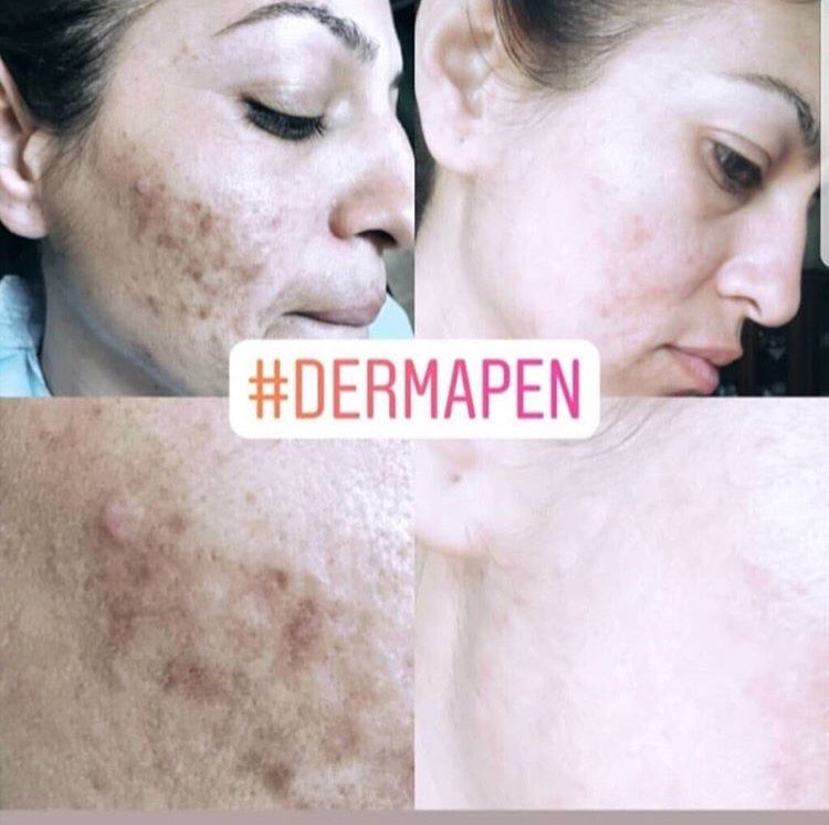 Yüzünüzdeki lekelerden tek seansta kurtulun #cosmelan #kesfet #altıniğne #dermatology #dermapen #bensilme #kaşkontür #kıltekniği #botox #botoks #dudakdolgusu #beylikduzu #esenyurt #kesfet #thy #avcilar #buzlazer #lazer #MetroTurizm #gidecekmisin #17Agustos1999