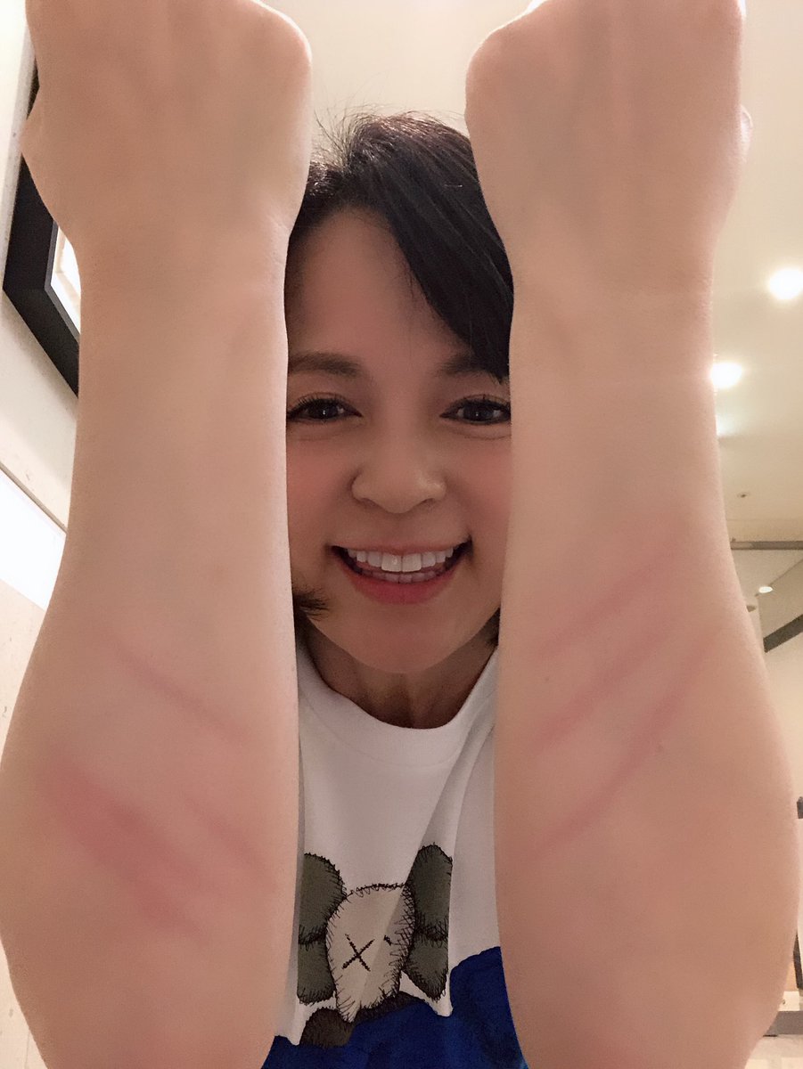 いとうまい子 今年も歳を重ねる日がやってきました いつも本当にありがとうございます 今年は まいまい Go Go で行くよ 画像は縄跳びの二重跳びを失敗して 腕にあたって出来た跡です すっかり身体が重くなった証拠ですが 二重跳びが昔の いとうまい子 今年も歳を重ねる日がやってきました いつも本当にありがとうございます 今年は まいまい Go Go で行くよ 画像は縄跳びの二重跳びを失敗して 腕にあたって出来た跡です すっかり身体が重くなった証拠ですが 二重跳びが昔の