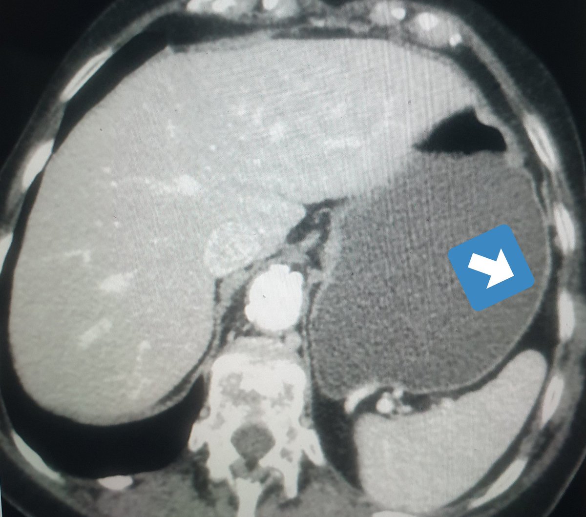 CTWORLD2's tweet image. Neutral oral contrast💧
وهي استعمال صبغه مشابهه ل
water attenuation (Density 0-30 Hu)
وغالبا يستعمل الماء لانه بيعطينا 
Better distension of stomach and GIT
فائدة الماء انه بيعيطنا الرؤية الاوضح لجدار المعده والامعاء ..
تحت تلاحظون جدار المعده well distended 
#الاشعة_المقطعية