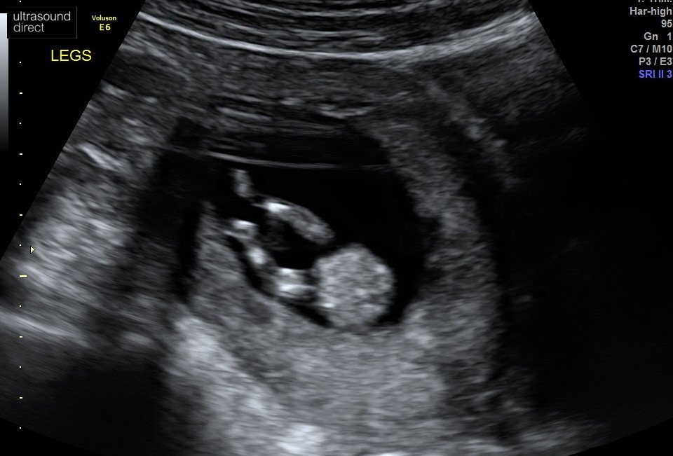 Unfruitful13's tweet photo. #11w4d unexpected bonus scans with the #NIPT bloods, we have a wiggly baby with full legs and fingers, so beautiful and magical #neverbeenthisfarbefore #hangonintherebaby #IVF5 #embryo11 #infertility #IVF #ICSI #IMSI #PICSI https://t.co/zY2vgIx1s9