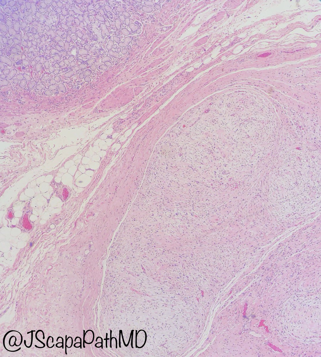 JScapaPathMD's tweet photo. .@StanfordPath Saturday!
📝47 year old man with anemia, found to have a gastric mass
🔬Single multinodular architecture with myxoid cellular areas composed of spindle cells separated by thick fibrous bands. Arborizing blood vessels
🦠SMA and Desmin +
#pathologytwitter #MedEd https://t.co/Dcibi6vjIS