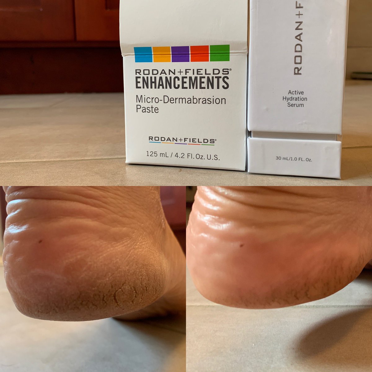 rlava2's tweet image. Needed to show my #feet some #love today &amp;amp; with these results after #1use you better believe I will continue for a week &amp;amp; post #results #rodanandfields #microdermabrasionpaste #activehydration #bodyreplenish #lifechangingskincare #women #loveyourbody