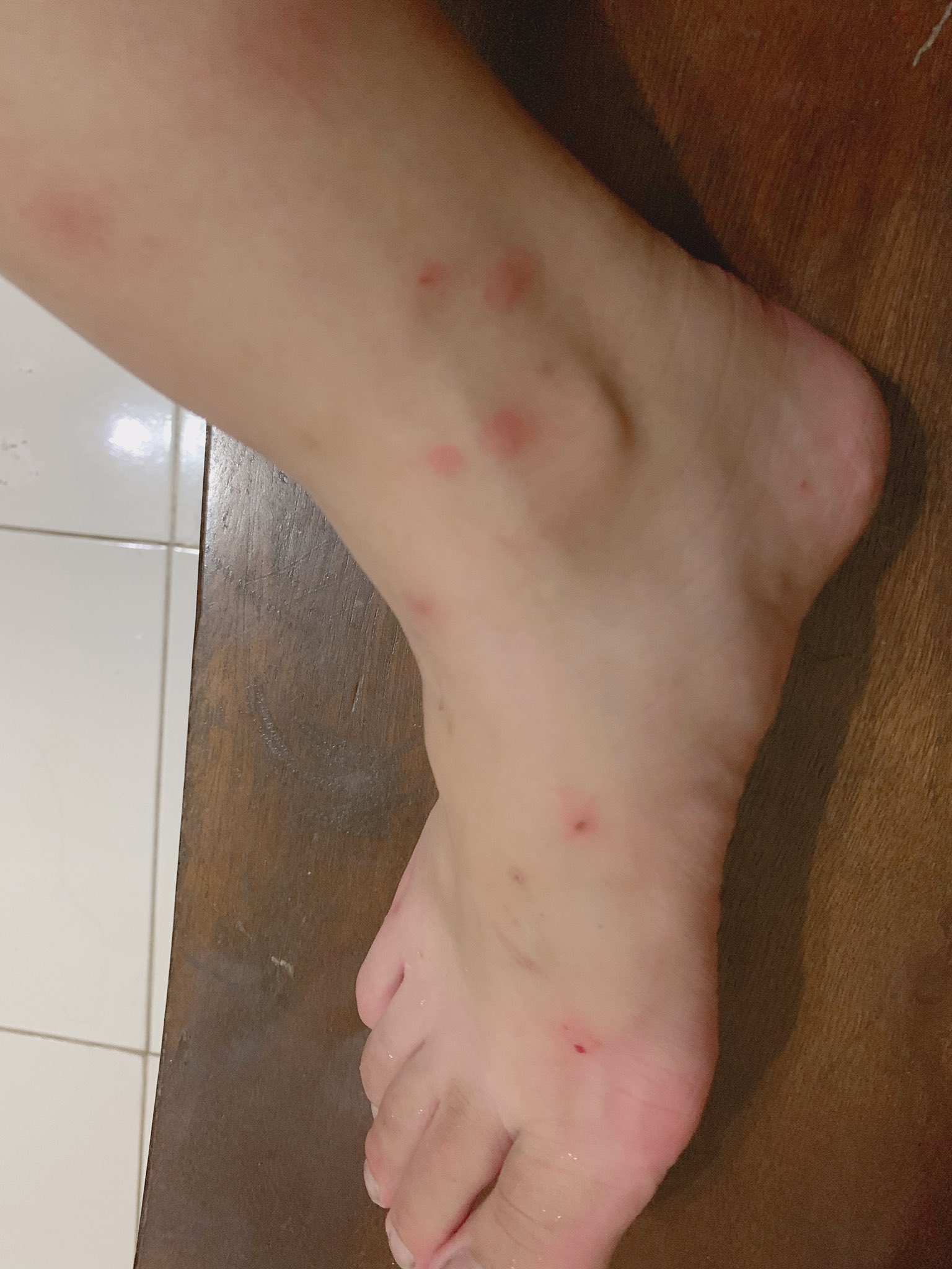 تويتر あきほ على تويتر 虫刺され やばくね 刺されるつーか噛まれてる説 教えて誰か詳しい人このちっちゃいの何 あきほのにかいめのいんどねしあ T Co Sjiyou7pl7