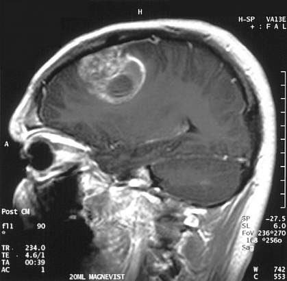 HidalgoMD_'s tweet photo. #SíndromeDeTurcot o "Síndrome de tumor cerebral y poliposis", es un trastorno hereditario caracterizado por el desarrollo de neoplasias malignas en el sistema nervioso central (ej. glioblastoma, medulobastoma) asociadas a poliposis adenomatosa familiar. https://t.co/TTllqKlu2S