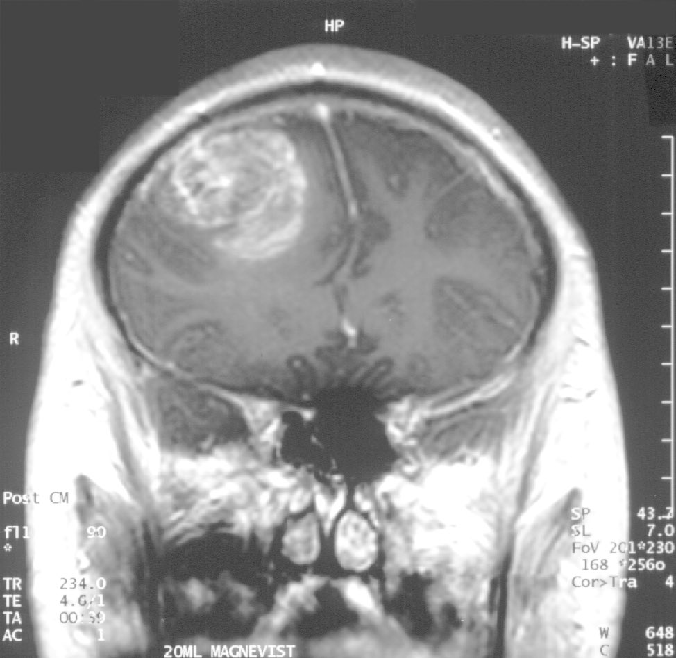 HidalgoMD_'s tweet photo. #SíndromeDeTurcot o "Síndrome de tumor cerebral y poliposis", es un trastorno hereditario caracterizado por el desarrollo de neoplasias malignas en el sistema nervioso central (ej. glioblastoma, medulobastoma) asociadas a poliposis adenomatosa familiar. https://t.co/TTllqKlu2S