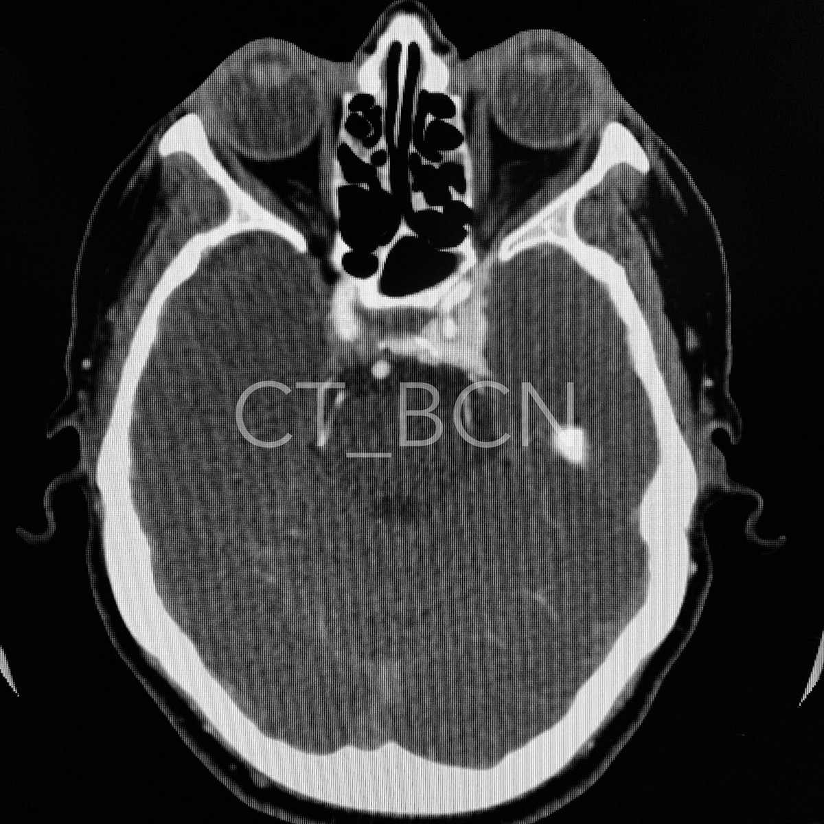 danyfcarame's tweet photo. ¿Cuál es su diagnóstico?
🇺🇸 What is your diagnosis?
@SERAM_RX @radiologyacr @residentesSERAM @RadResidentARRS
#Rad2B #radbasics @sociedadSENEC @AANSNeuro @seneurologia @AANMember @SERAUWeb @seacv_esp https://t.co/8GQ74tq5d2