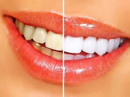 omilights's tweet photo. #yellowTeeth #staininginTeeth #dentalHealth #strongGums https://t.co/YpLaByT7LN
It depends upon daily care routine, that maintains the healthy and white spark in teeth. But we normally do not take care of our mouth health as much as we give to external physical health. https://t.co/pxt3Z17UMI
