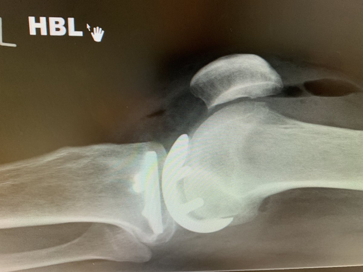 Superb accuracy of cuts and implant positioning with #MAKO Robot arm-assisted surgery. First #partialknee xrays matching well to the surgical plan. A comfortable experience for the patient with minimal pain and swelling. Discharge on Day 2. #improvingpatientoutcomes