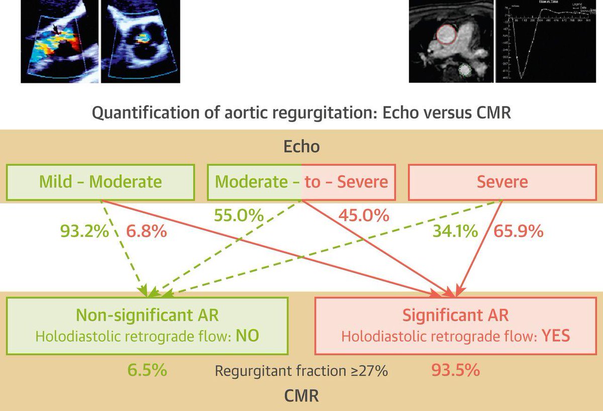 New #JACCIMG study shows that #CMR significantly reclassifies #vhdAR severity vs. #cvEcho. Furthermore, by assessing CMR retrograde flow in the descending aorta, holodiastolic retrograde flow was a strong predictor of outcomes. fal.cn/33w42