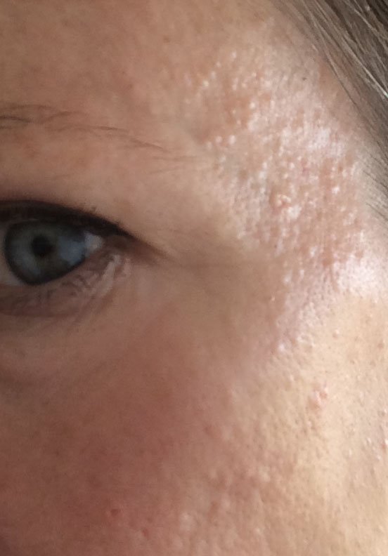 ColitisDiary's tweet image. Yay, colitis skin. Note to self: Drink more water babe.