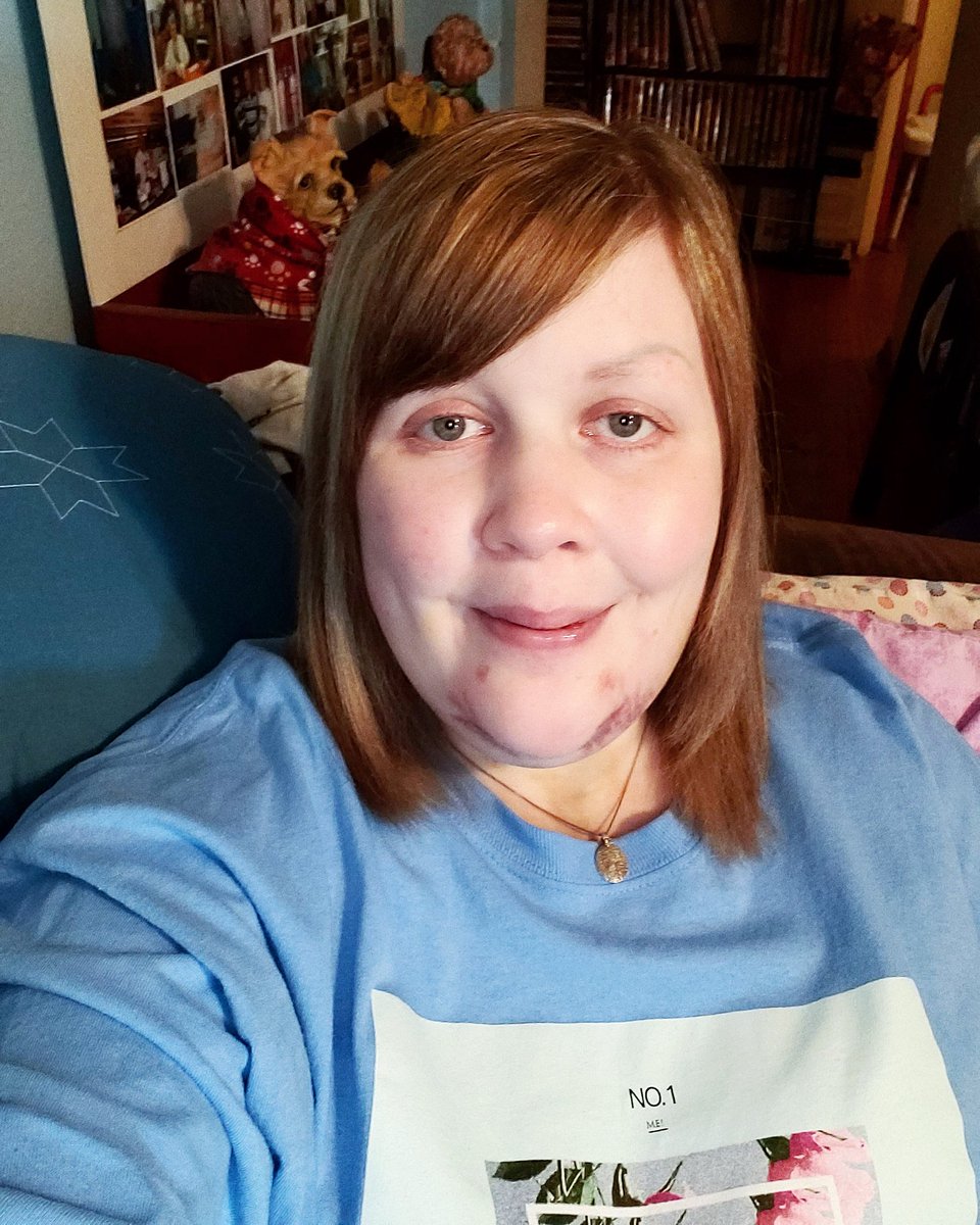 AshleyHLovesTay's tweet photo. "With every guitar string scar on my hand", or on my face as u can see. Don't mind purple & blue bruises from surgery. In love w/"Lover".πIt's pure & angelic. Can't wait 2 get my deluxe album! Love u Tay! Hope 2 meet u @taylorswift13 ! @taylornation13 #LoverIn5Days #Lover https://t.co/ov4Pe4HR66