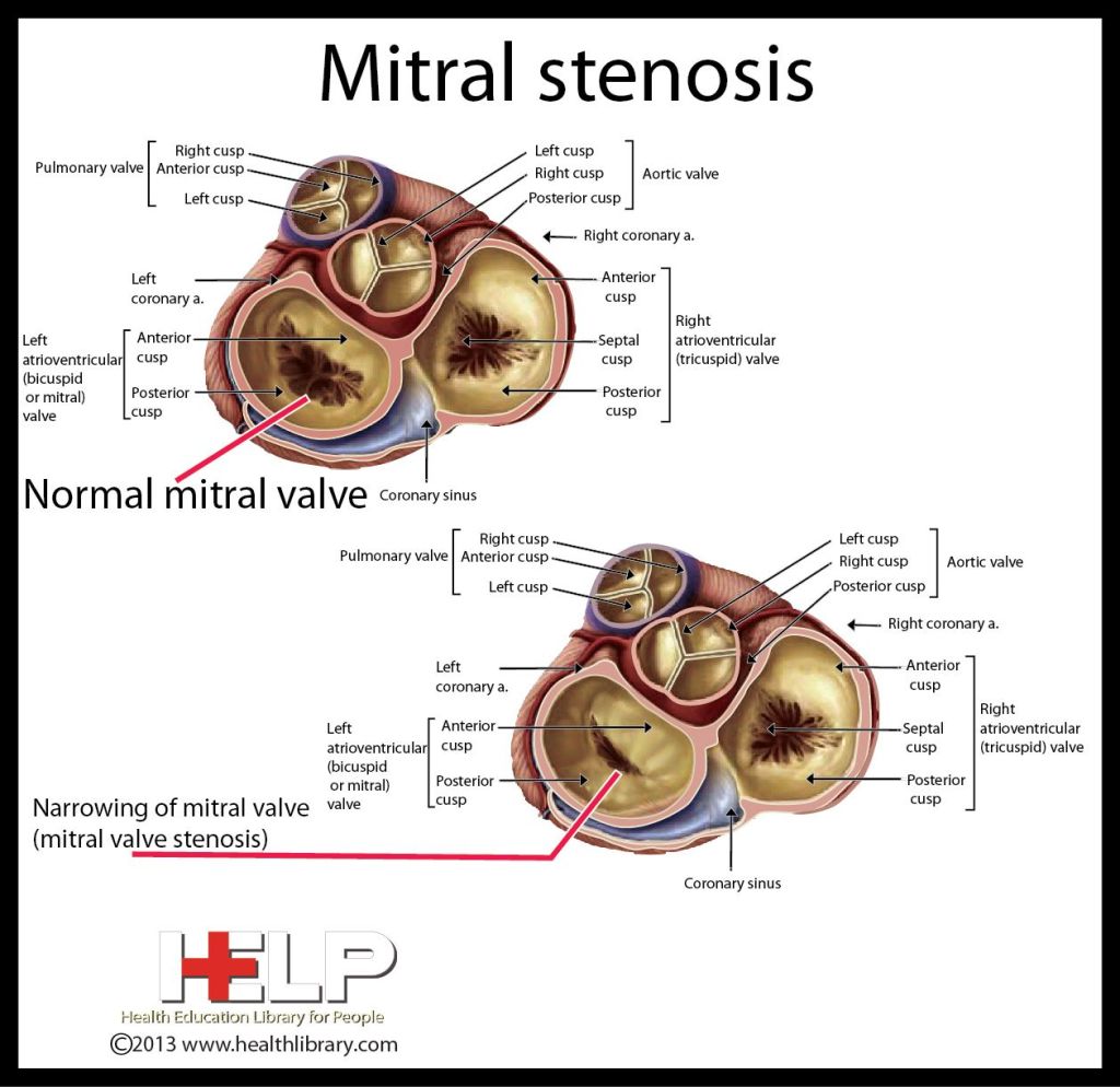 swostik_devkota's tweet photo. MITRAL VALVE STENOSIS: Introduction, Clinical features &amp; Management https://t.co/y9yn9mUvxt https://t.co/lZaLKtYUnJ