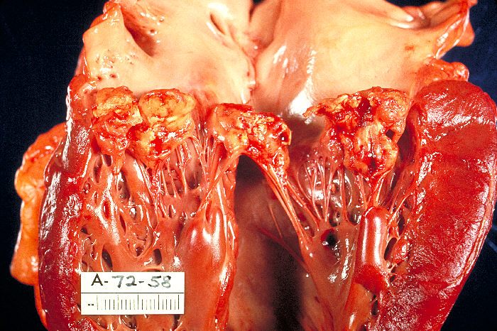 swostik_devkota's tweet photo. INFECTIVE ENDOCARDITIS: Introduction, Etiology, Clinical features, Diagnosis &amp; Management https://t.co/Vfw9sVax0u https://t.co/FDLfKPaurL