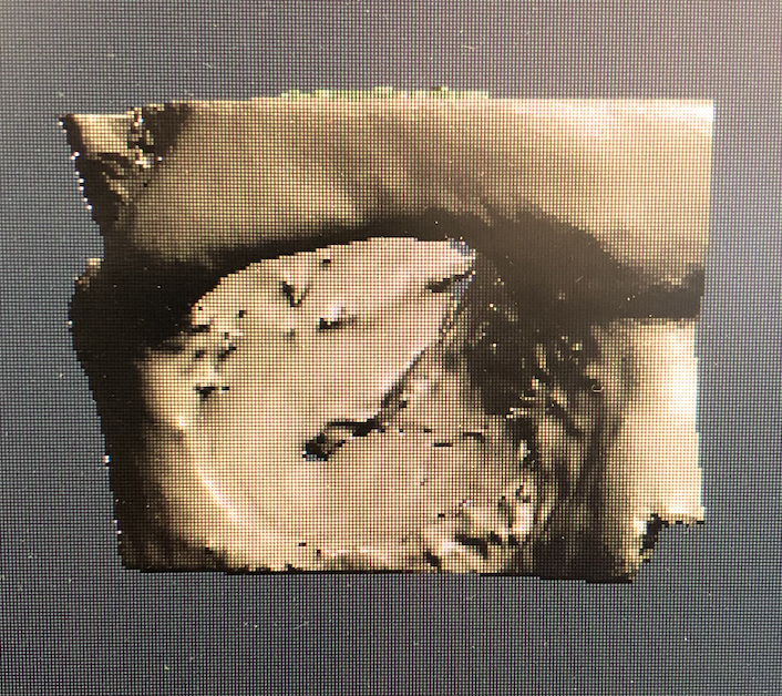 3d_maranon's tweet photo. This 3D model was obtained by a mirroring technique of the healthy orbital floor. It will be implemented to pre-adjust the plate needed to hold the orbital bone. 
Fablab team: @rupermac @calvoharo_ja @diegotrap @AbyAmselem https://t.co/WLju4LKxde