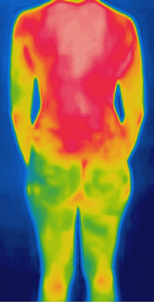 thermogramer's tweet photo. ⚠️ That's what happen when you don't protect your skin with sunscreen☀️. Your cells get damaged and your body respond with inflammation🎈, pain 🤕 and temperature increase🌡️. Remember to use broad spectrum sunscreen. 
.
#selfcare #sunburn #summer #sunbathing #sunscreen https://t.co/3H4gBbrmo3