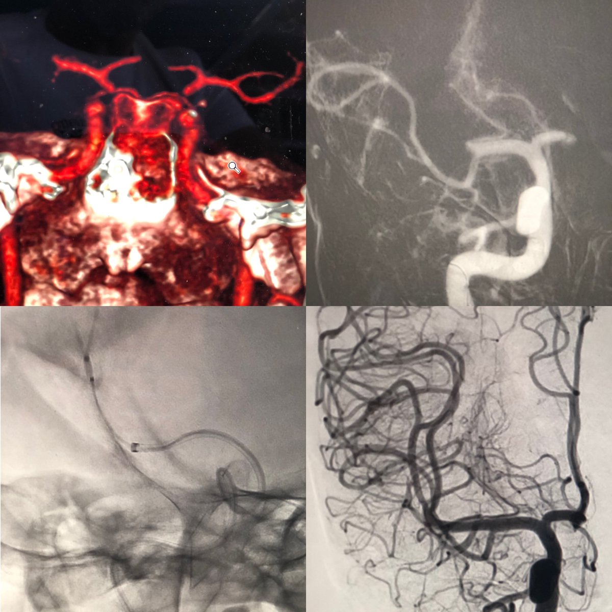 Claudio Rodríguez Fernández (@dr_crdguez) on Twitter photo ✅ #teleictus 🤒 con oclusión de gran vaso en 🏥 <a href="/Hosp_Villalba/">Hospital de Villalba</a> valorado ☎️👨⚕️👨🏼💻 en ⏱ real desde U. de Ictus 🔄🏥 <a href="/HUReyJuanCarlos/">Hosp.Rey Juan Carlos</a> x <a href="/Jose_FFerro/">José Fernández Ferro</a> desplazamiento de NeuroTeam 🚑 TICI 3 tiempo record evitando movilizar a los pctes y familiares. Gran trabajo en Equipo👏🏽💪 #Stroke ✅ #teleictus 🤒 con oclusión de gran vaso en 🏥 <a href="/Hosp_Villalba/">Hospital de Villalba</a> valorado ☎️👨⚕️👨🏼💻 en ⏱ real desde U. de Ictus 🔄🏥 <a href="/HUReyJuanCarlos/">Hosp.Rey Juan Carlos</a> x <a href="/Jose_FFerro/">José Fernández Ferro</a> desplazamiento de NeuroTeam 🚑 TICI 3 tiempo record evitando movilizar a los pctes y familiares. Gran trabajo en Equipo👏🏽💪 #Stroke