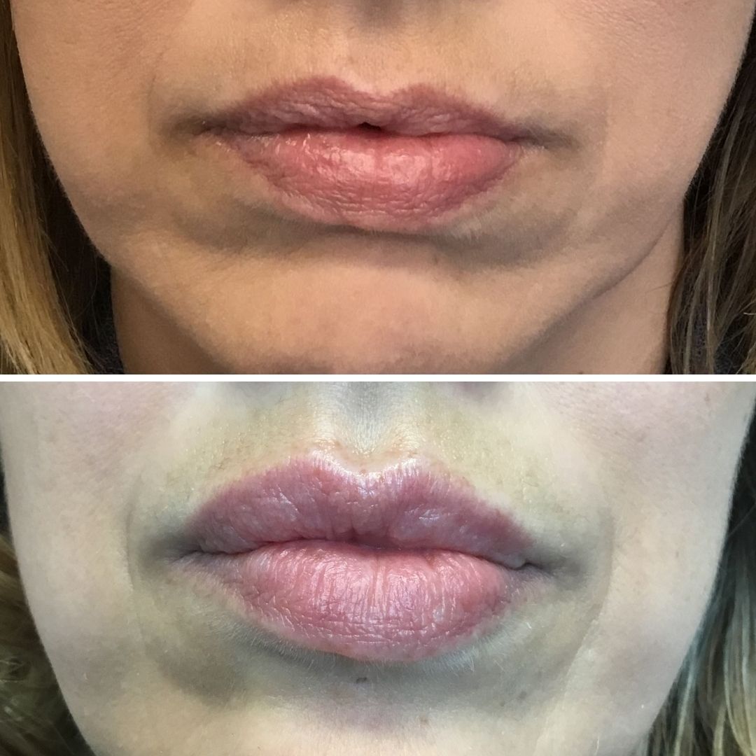 Beauty_GTA's tweet photo. Beautiful lips for our beautiful patient! 1 syringe of Teoxane #RHA2 was used, the patient super thrilled with her results! 💋
-
#LipInjections #Fillers #BramptonCosmetic https://t.co/Dcd3iuVFTP