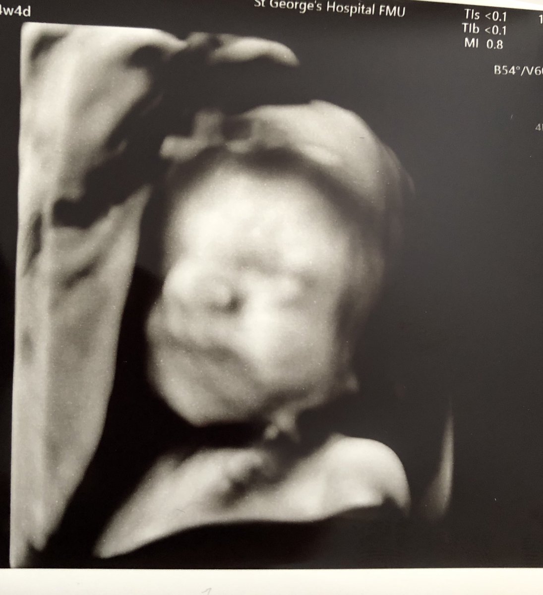 tubesdontwork's tweet photo. 24 week scan today and all good. Little bubba is 1lb 14oz. Still go in expecting the worst so is always a nice relief to come out with good news. Next scan 30 weeks which seems ages away at the mo! #pregnancyafterloss #ivf #infertility #firstFET https://t.co/rZtVNcYROg