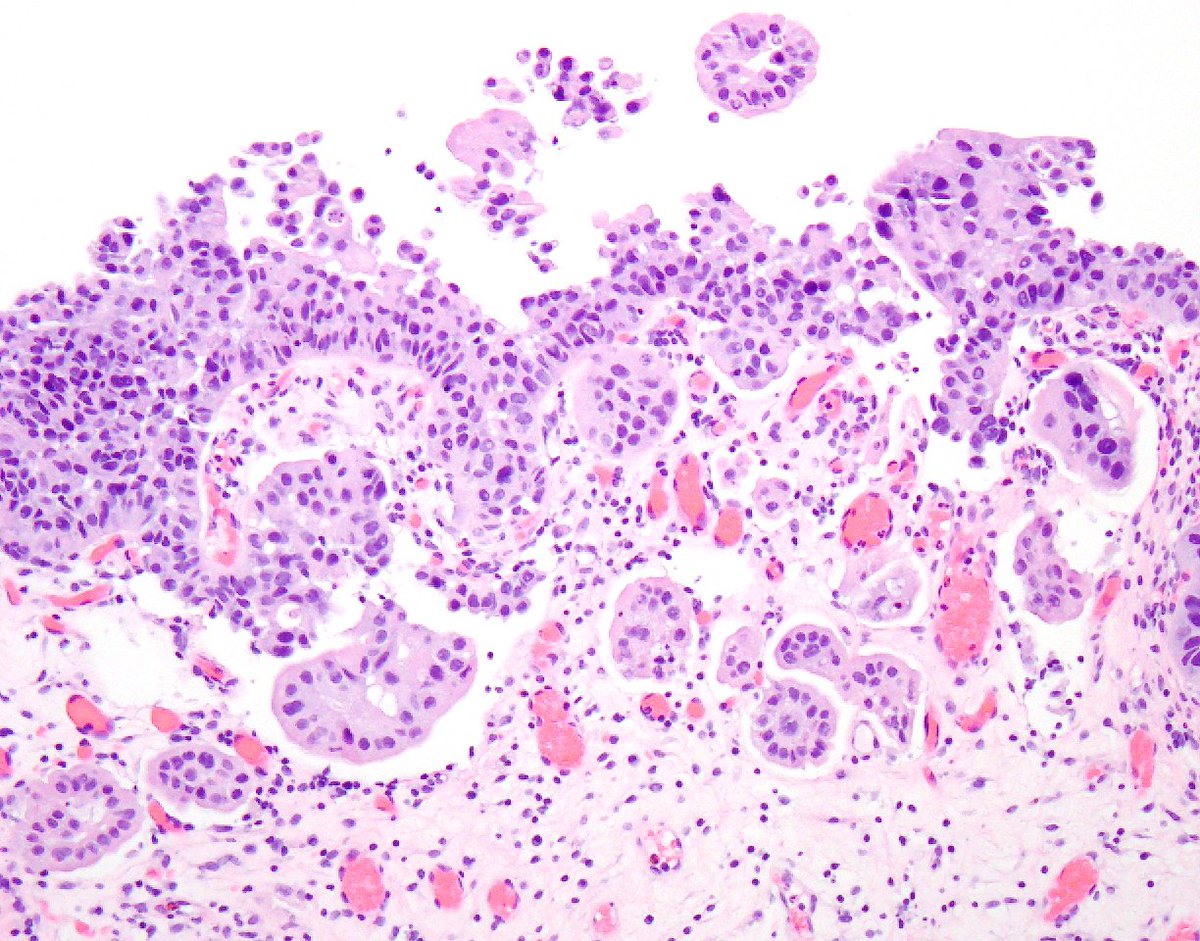 #bladdercancer w/features diagnostic of superficial pT1 (lamina propria) invasion ▶️ small, irregular nests ▶️ 'paradoxic differentiation'=tumor cells more pink cytoplasm than in non-invasive component ▶️ retraction ▶️ loss of capillary network/'cuff' around tumor nests #gupath