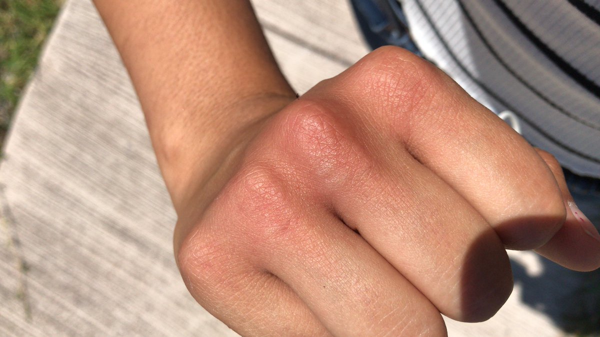 sof_davila's tweet photo. Hoy un wey me apretó las pompis mientras yo bajaba del camión, creo que ahora lo va a pensar dos veces antes de volver a hacerlo por que traigo hasta sus dientes marcados https://t.co/0x2jzSCAYA