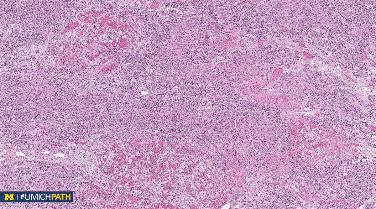 UMichPath's tweet image. A: PEComa. A rare tumor with perivascular epithelioid cell differentiation. Aggressive behavior predicted by size &amp;gt;5 cm, infiltrative growth, hypercellularity, mits (&amp;gt;1/50 HPF), high-grade nuclei, and necrosis. IHC: Positive for sm. muscle &amp;amp; melanocytic markers. #GYNPath #DailyDx