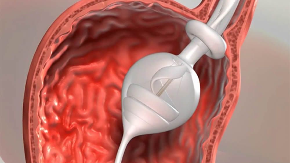 SaluDigital_CS's tweet image. La #FDA aprueba un balón gástrico inteligente 

➡️ consalud.es/saludigital/15…
