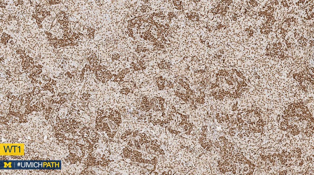 UMichPath's tweet image. We're sharing 2 cases today since we missed #GYNPath Day 5 last week.

What’s your #DailyDx of this uterine mass?

We’ll tweet the answer and some quick facts tomorrow! #UMichPath