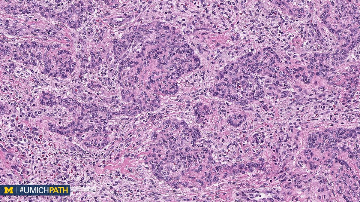 UMichPath's tweet image. We're sharing 2 cases today since we missed #GYNPath Day 5 last week.

What’s your #DailyDx of this uterine mass?

We’ll tweet the answer and some quick facts tomorrow! #UMichPath