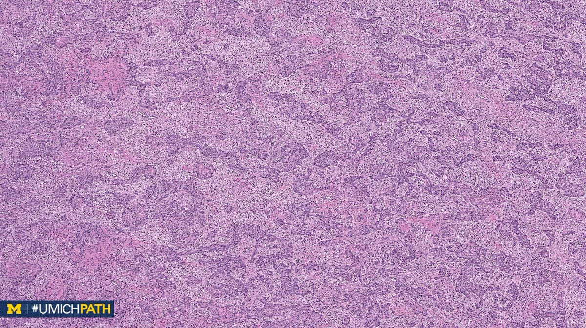 UMichPath's tweet image. We're sharing 2 cases today since we missed #GYNPath Day 5 last week.

What’s your #DailyDx of this uterine mass?

We’ll tweet the answer and some quick facts tomorrow! #UMichPath
