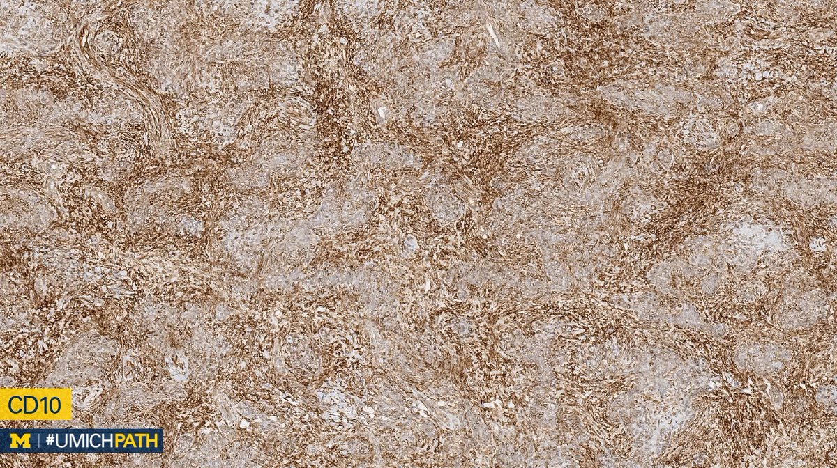 UMichPath's tweet image. We're sharing 2 cases today since we missed #GYNPath Day 5 last week.

What’s your #DailyDx of this uterine mass?

We’ll tweet the answer and some quick facts tomorrow! #UMichPath