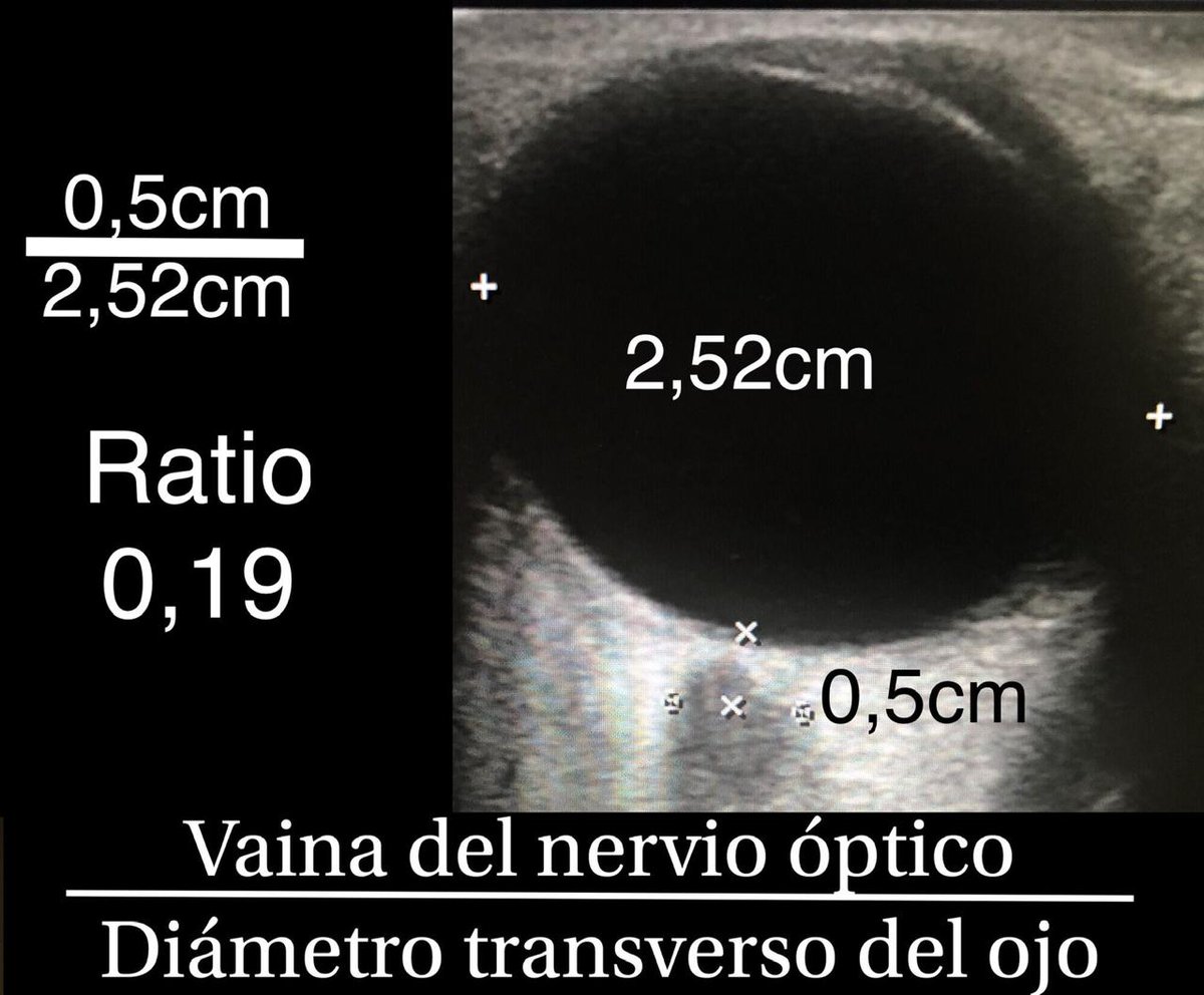 Seguimos estudiando si vale la pena modificar nuestro protocolo
Punto de corte para riesgo de cráneo hipertensivo 0.25